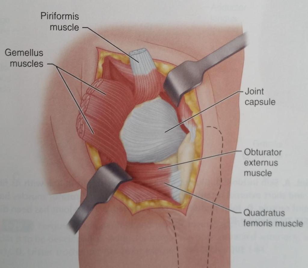 POSTERIOR APPROACH TO THE HIP (OSBORNE) Rotate the thigh internally, detach the tendons of the piriformis and gemelli muscles near their insertions into the trochanter, and retract the muscles