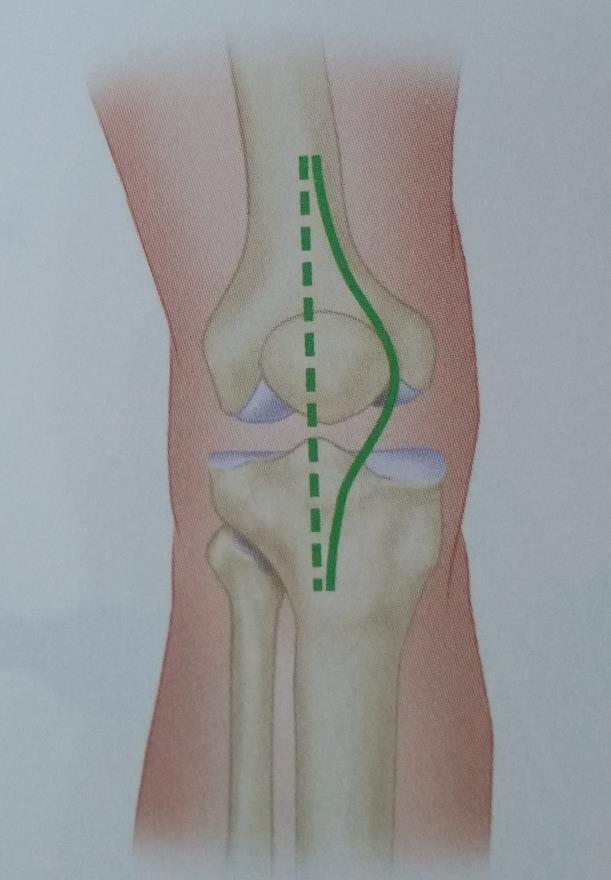ANTEROMEDIAL PARAPATELLAR APPROACH (VON LANGENBECK) Begin the incision at the medial border of the quadriceps tendon 7 to 10 cm