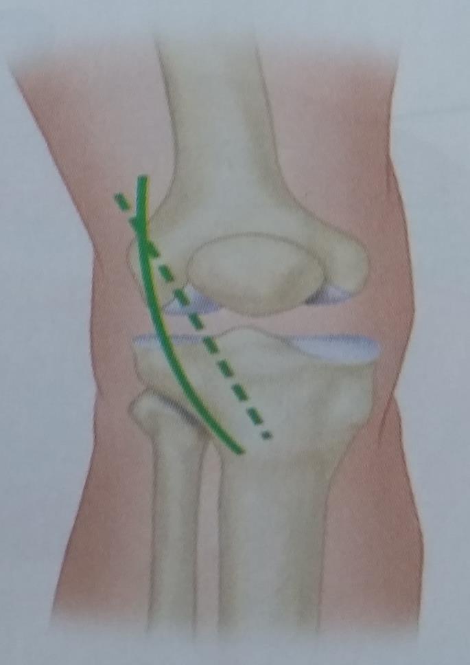 ANTEROLATERAL APPROACH TO THE KNEE Usually the anterolateral approach is not as satisfactory as the anteromedial one, primarily because it is more difficult to displace the patella medially than
