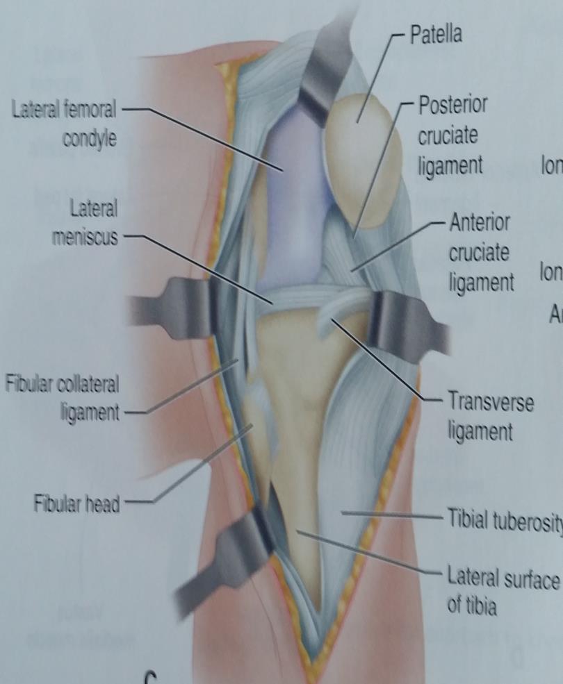 ANTEROLATERAL APPROACH TO THE KNEE (KOCHER) Begin the incision 7.