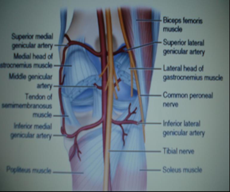 DIRECT POSTERIOR APPROACH TO THE KNEE Expose the popliteal artery and vein, which lie directly anterior and medial to the tibial nerve.