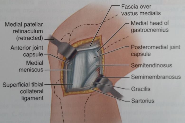 MEDIAL APPROACH TO THE KNEE (HOPPENFELD AND DEBOER) Flex the knee further, and