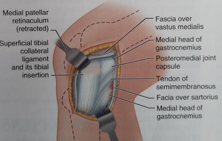 gracilis muscles Retract all three components of the pes anserinus
