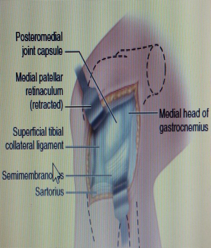 MEDIAL APPROACH TO THE KNEE (HOPPENFELD AND DEBOER) To expose the posterior third of the medial meniscus and the