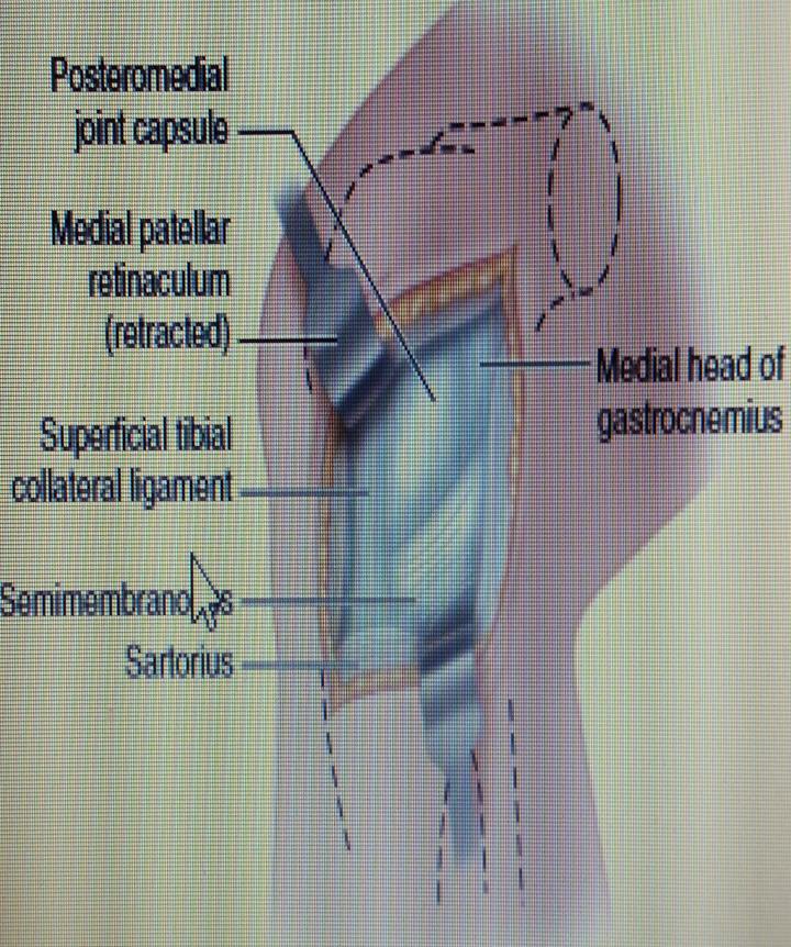medial head of the gastrocnemius muscle from the posterior capsule of the knee almost to the midline by blunt