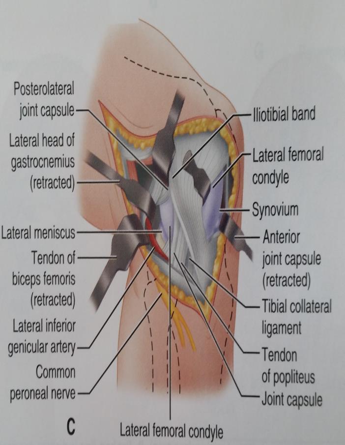LATERAL APPROACH TO THE KNEE Widely mobilize the skin flaps anteriorly and posteriorly.