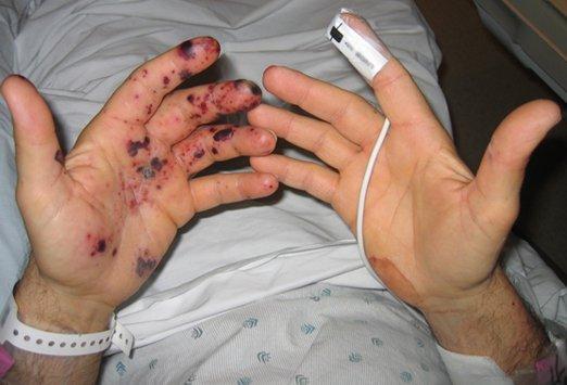 Infective vasculitis of the LEFT hand Seen with necrosis This is indicative of staphycoccal
