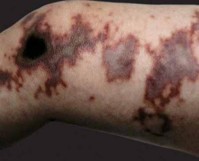 Meningococcal rash The dark color (purpura) : a rash of purple spots on the skin caused by