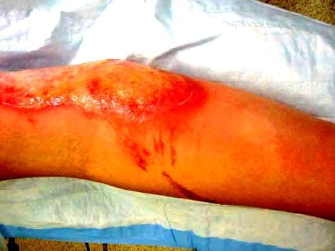 Cellulitis following burn wound