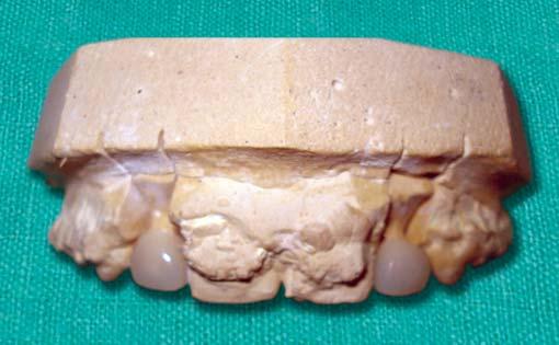 15: Provisional crowns in relation to 12 and 22 DISCUSSION Treatment of tooth loss or agenesia in the anterior maxilla with single-tooth implant supported crowns is well documented (Jemt et al, 1990;