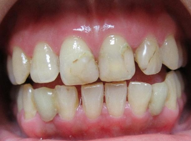However, the patient should still be dentally motivated and caries and periodontal disease should be controlled before placing fixed prosthodontics.