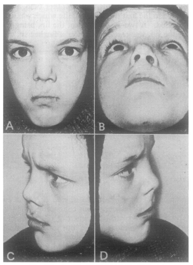 176 BRITISH JOURNAL OF PLASTIC SURGERY relationship underneath is different, giving wider nostrils.