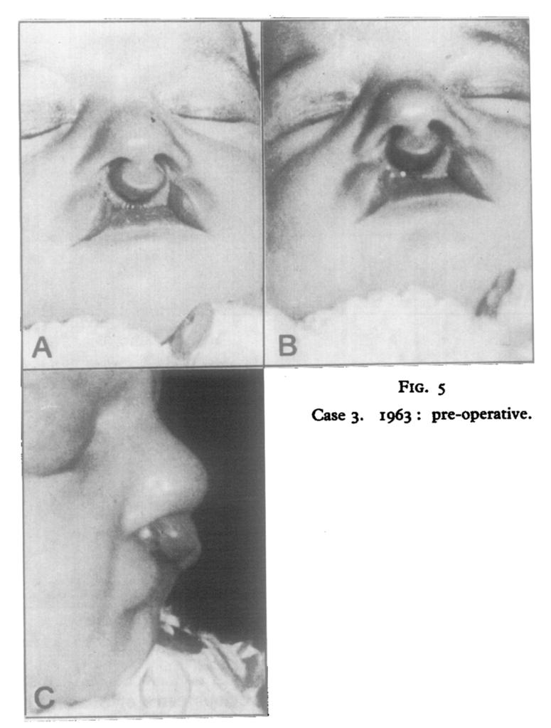 The lateral portions of the lip were rotated and brought medially and sutured below the central portion to prevent any pulling on the central portion of the lip. This gave a notching FIG. 5 Case 3.