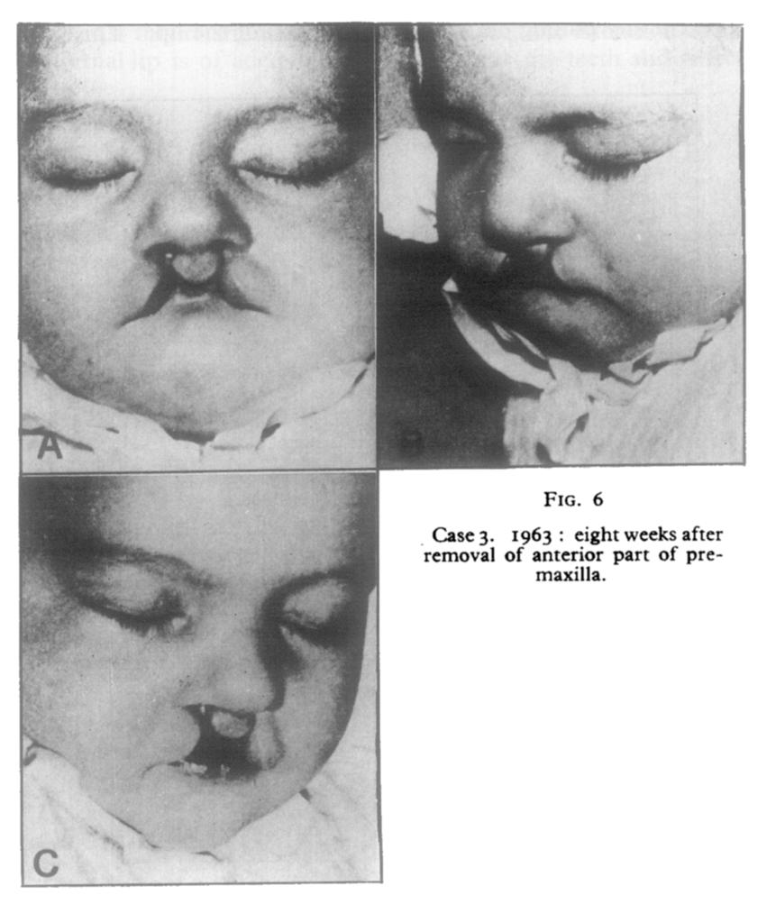 Photographs demonstrating cases of nasal tip deformity should give a view from below for correct comparison.