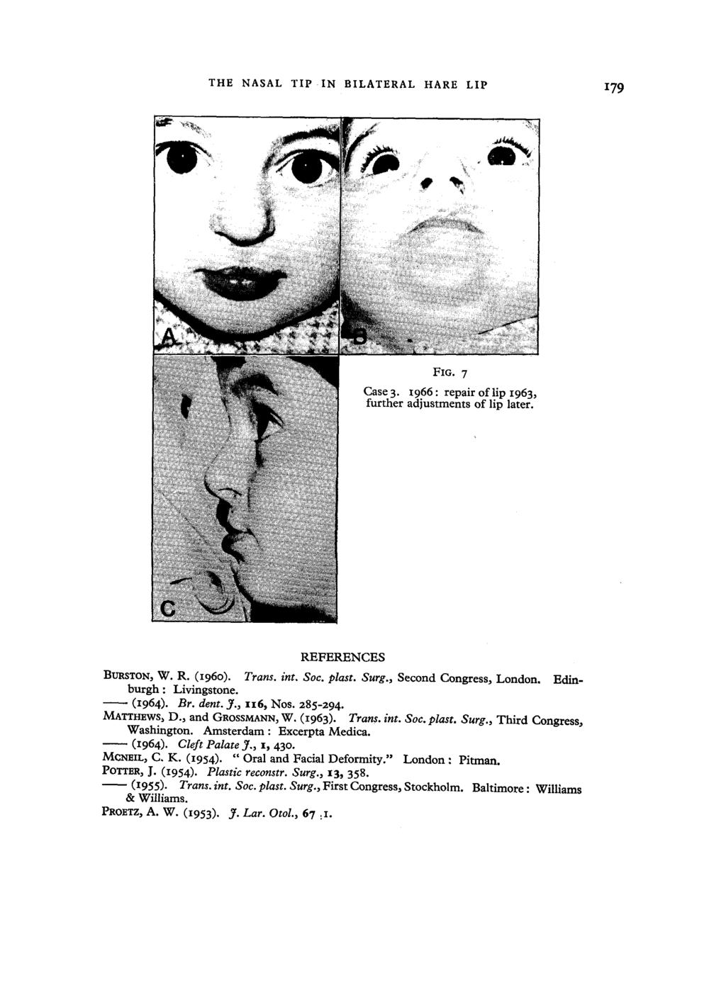 THE NASAL TIP IN BILATERAL HARE LIP 179 FIG. 7 Case 3. 1966 : repair of lip 1963, further adjustments of lip later. REFERENCES BURSTON, W. R. (196o). Trans. int. Soc. #last.