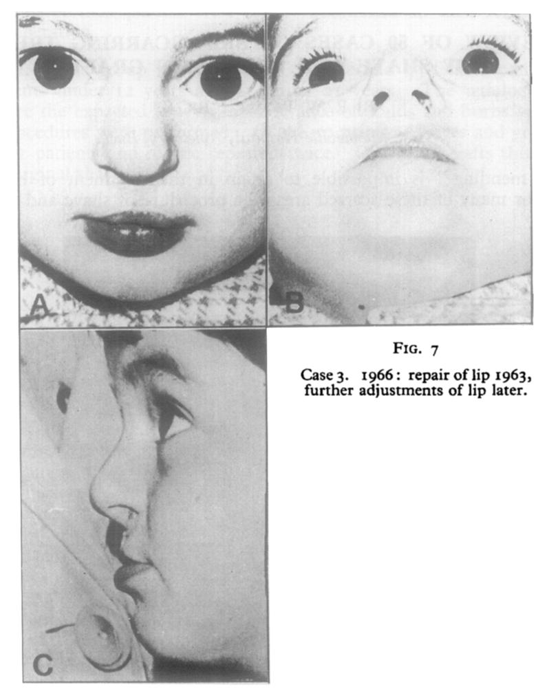 , Third Congress, Washington. Amsterdam : Excerpta Medica. (I964). Cleft Palate J., i, 43o. MCNEIL, C. K. (1954). " Oral and Facial Deformity." London : Pitman. POTTER, J.