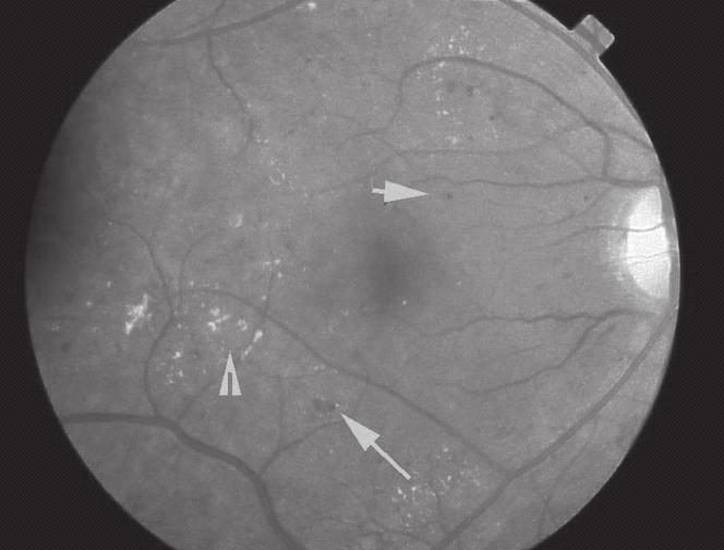 03 FIGURE 1: FUNDUS PHOTOGRAPH OF EARLY BACKGROUND DIABETIC RETINOPATHY SHOWING
