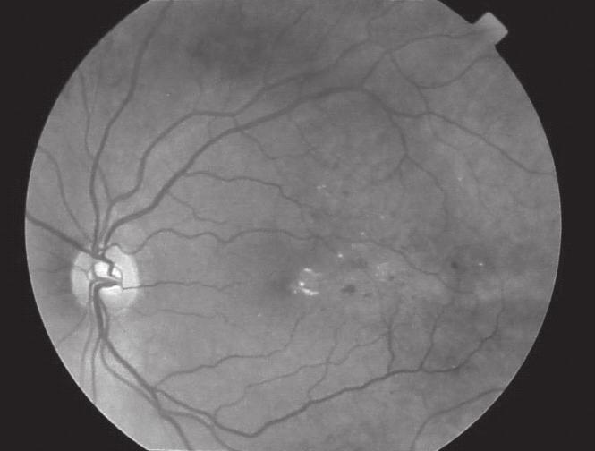 PHOTOGRAPH OF CLINICALLY SIGNIFICANT MACULAR