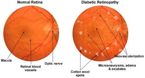 Microvascular complications; Hyperglycaemia and retinopathy; - Stage I (non-proliferative); Increased retinal capillary permeability and dilation Formation of micro-aneurysms Haemorrhage - Stage II