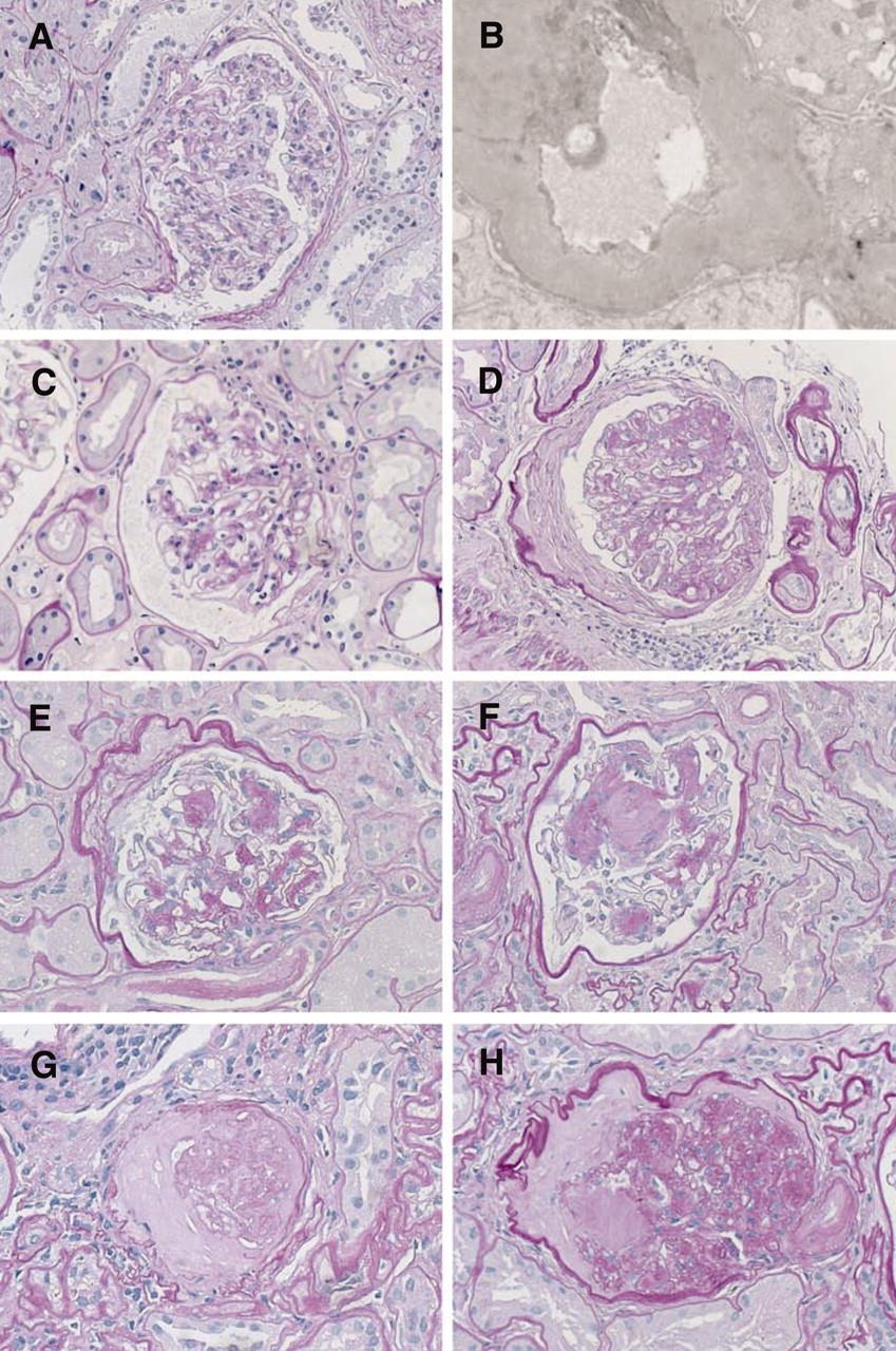 A and B Glomerulus showing only mild ischemic changes C, D Class II glomeruli with mild and moderate mesangial