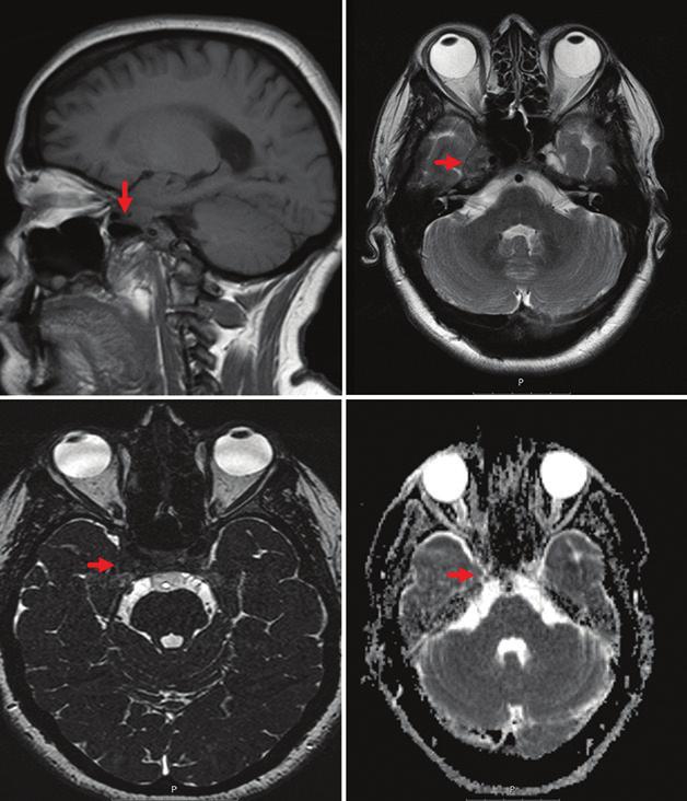 During surgery, the lesion ws menle to e seprted from the durl envelope of the cvernous sinus nd ws completely resected [Figure 3].