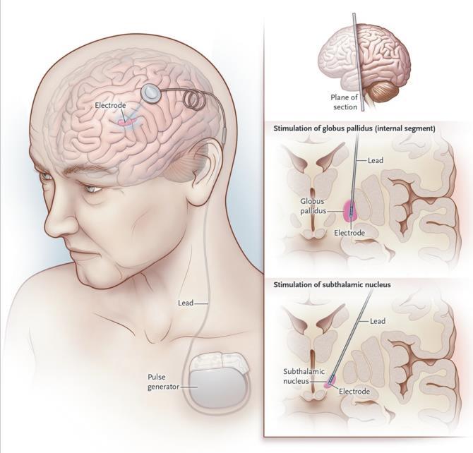 Functional Neurosurgery Deep brain stimulation FDA approved for: Essential tremor (1997) Parkinson s disease (2002) Dystonia (2003)