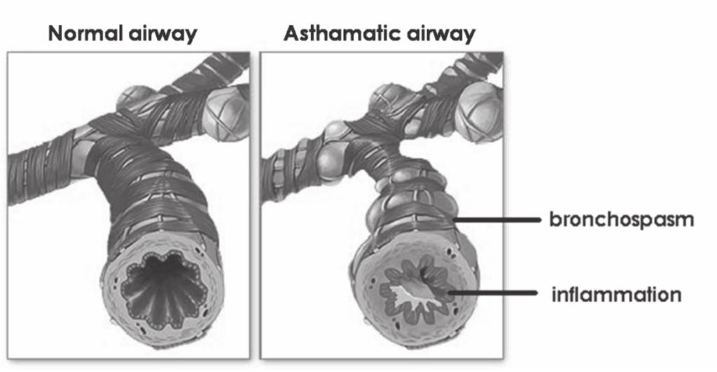 narrowing the airway lining called as- BRONCHOSPASM, while swelling & redness