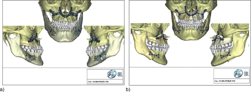 A. KERBRAT, J.B. KERBRAT, A.S. BOURLON, T. SCHOUMAN, P. GOUDOT Figure 3 a) Simulation of surgery with a cutting guide and pre drilling. b) Simulation of surgery with osteosynthesis plates.