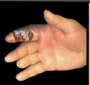 pandactilitis pandactilitis is nonspecific purulent - necrotic lesions of a finger extending not less