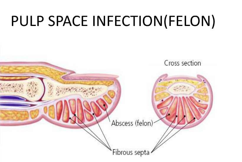 x x Fibrous septa prevent pus from spreading under skin to periphery.