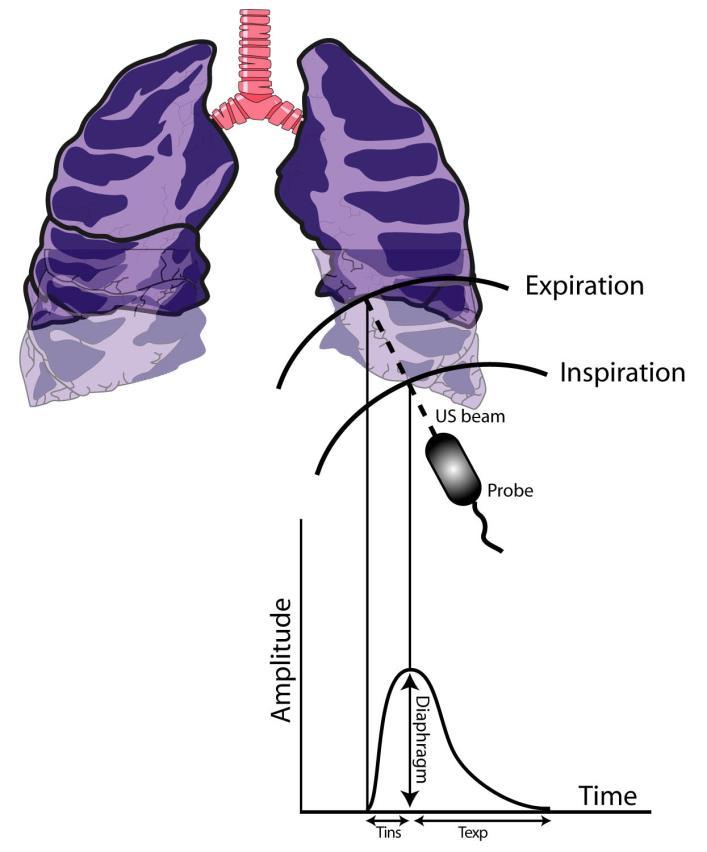 M-mode US: Interrogation of each hemidiaphragm in the longitudinal plane Recording of at least 4 respiratory cycles during spontaneous