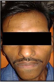 Fig 1: A frontal view of the patient demonstrates facial asymmetry with firm swelling in chin region Fig 2: Intraoral examination of the patient demonstrates a large mandibular mass.