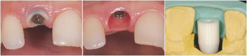 11 old crown with perforated post, and root resorption Implant placement after ridge reconstruction and X-Ray Situation with