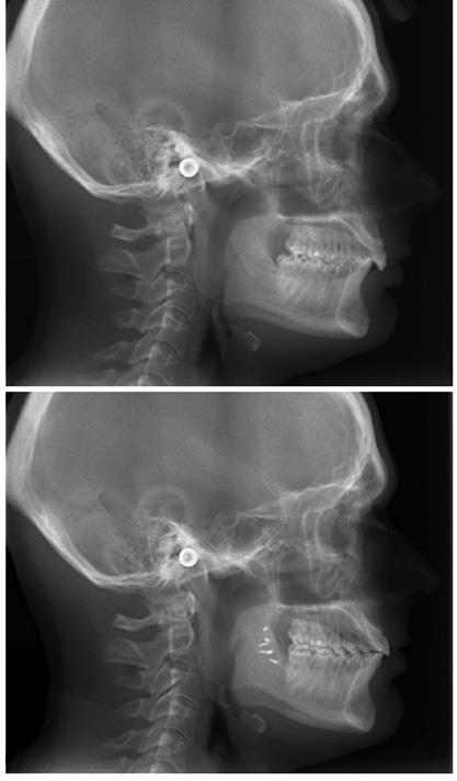 CHAPTER 9 A B Figure 2 (A) Pre-operative lateral cephalogram confirming the retrognathic mandible with a deep bite and a corresponding deep mental fold.