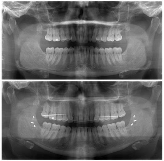 EXPERIENCING YOUR OWN ORTHOGNATHIC SURGERY A B Figure 3 (A) Pre-operative orthopantomogram. No pathology is visible. (B) Postoperative orthopantomogram 1 year after surgery.