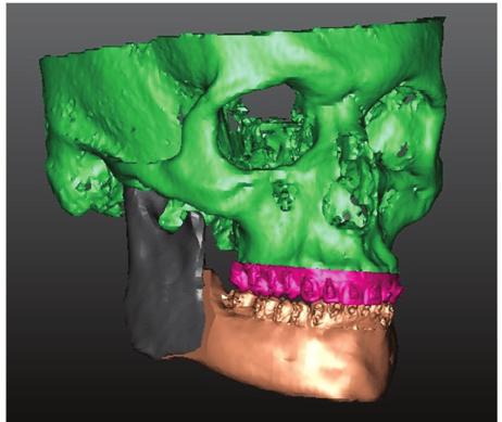 the chin. Figure 5 Simplant 3D planning.
