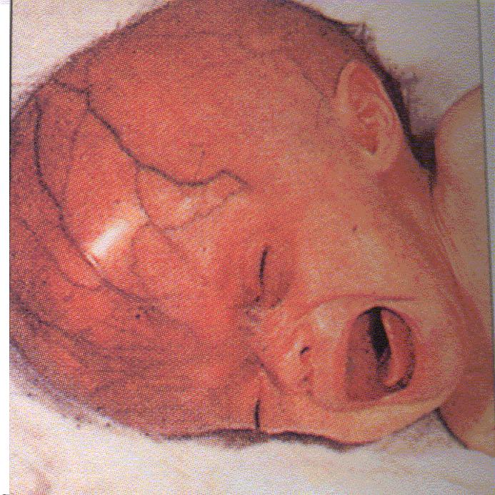 Case A newly born baby was born with Hydrocephalus, convulsions and fever. His mother gave a history of having a cat at home a- What is your provisional diagnosis? Congenital toxoplasmosis.