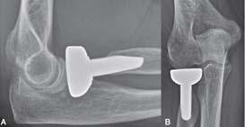 Non-anatomic Reconstructions: Complications Edge loading may occur from overstuffing or maltracking May