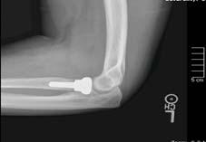 Case Example #2: RHA s/p radial head fracture