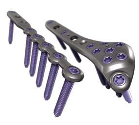Multiple sizes available to suit a wide array of patients Fibula Plating System Engineered from TiMAX for