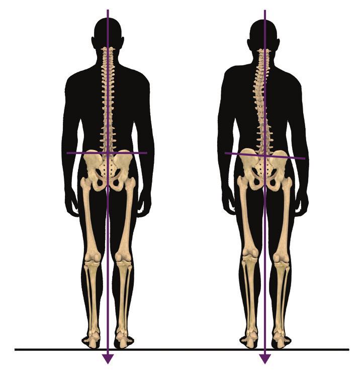 What is a Limb Length Discrepancy (LLD)? A limb length discrepancy (LLD) is a difference between the lengths of the upper and/or lower limbs.