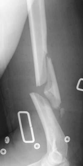 NONOPERATIVE TREATMENT Hanging Arm Cast Coaptation Splint