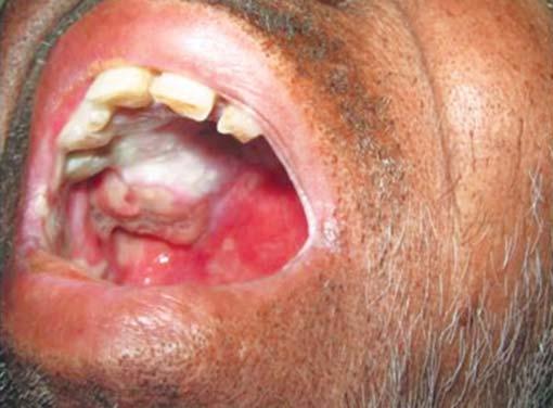 lthough a single patient from group 1 had grade 3 mucositis, the patient complained of moderate pain, this might be attributed to the antiinflammatory and anesthetic property of the oral rinse.