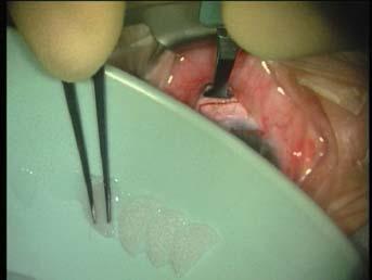 (Figure 08 Polyvinylalcohol sponges being folded) (Figure 09 PVA sponge being inserted avoiding the cut edge of conjunctiva) We attempt to treat as large an area as possible, including under the