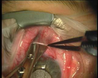 The conjunctiva should be handled very gently to avoid buttonholing, particularly if antimetabolites are used. If a limbus based flap is used, the incision should be made far into the fornix.