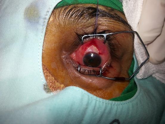 536 Figure 3: A well-formed fornix based conjunctival flap with a well-placed traction suture in place.