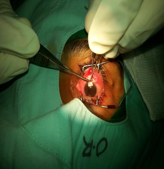 538 Figure 6: Peripheral iridectomy being done.