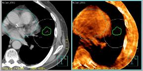 Avoid Organs at Risk Heart Avoid Organs at Risk Patient Re-Positioned ITV PTV Planning CT - Target Localized - Heart Inside