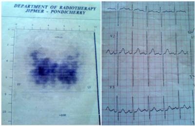 Figure 1 Figure 1: Left: Radio iodide scan showing increased radioiodine uptake; right: ECG showing sinus tachycardia Figure 2 Figure 2: Hurthle cell change with lymphocytic infiltrate reminiscent of
