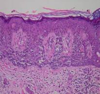 Histopathology RCM More of the lesion is able to be evaluated!